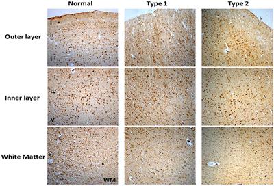 Differential Sphingosine-1-Phosphate Receptor-1 Protein Expression in the Dorsolateral Prefrontal Cortex Between Schizophrenia Type 1 and Type 2